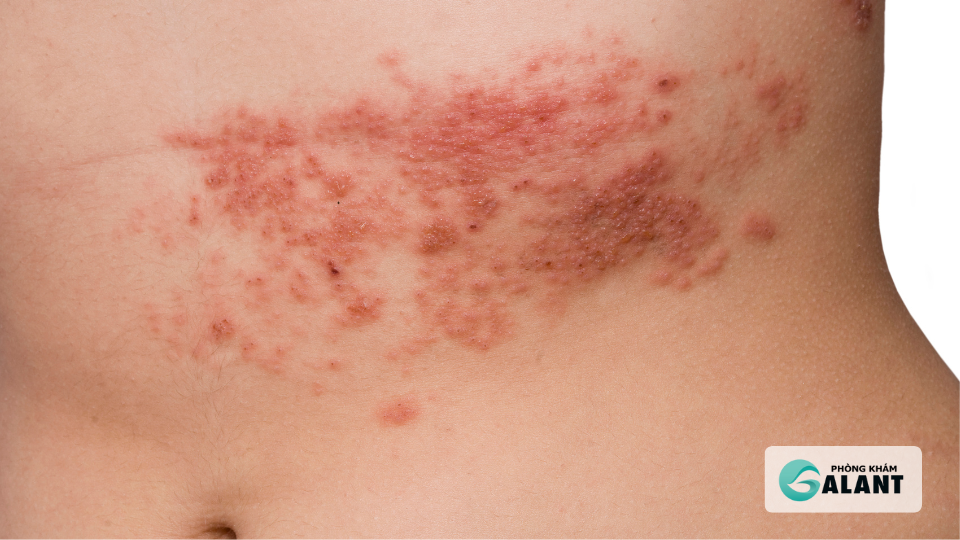 Triệu chứng Herpes sinh dục ở nam & nữ