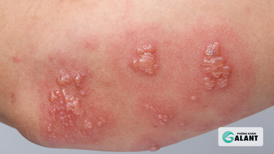 Các phương pháp xét nghiệm HSV (Herpes sinh dục)