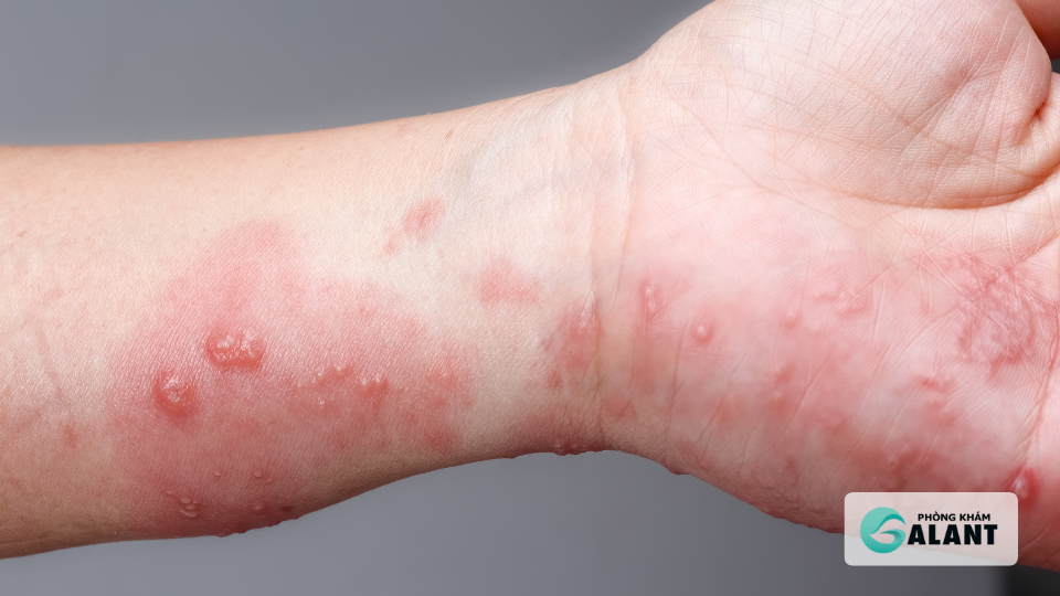 Nguyên nhân và con đường lây nhiễm Herpes sinh dục