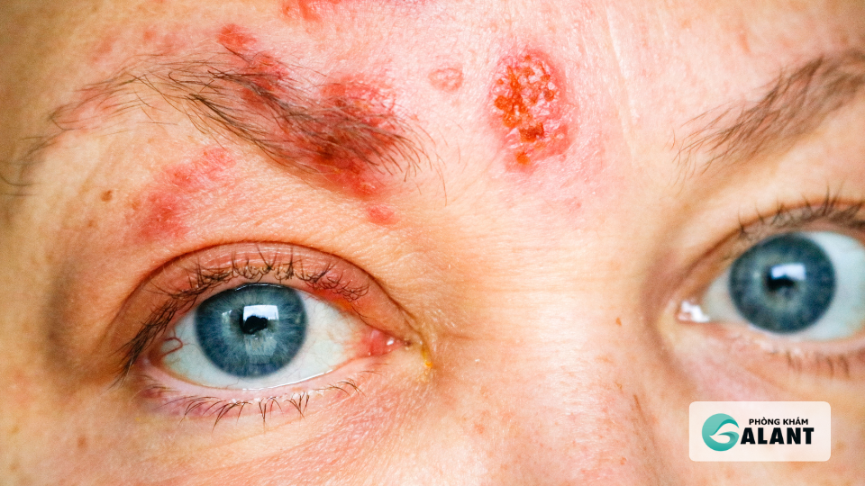 Biến chứng Herpes sinh dục: Nguy hiểm không thể xem nhẹ