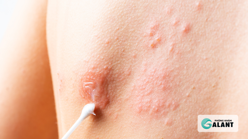 Cách phòng ngừa Herpes sinh dục: Chủ động bảo vệ chính mình và người thương