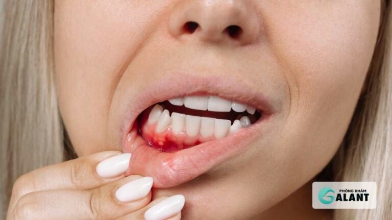 Sùi mào gà có lây qua hôn khi có viết thương ở miệng