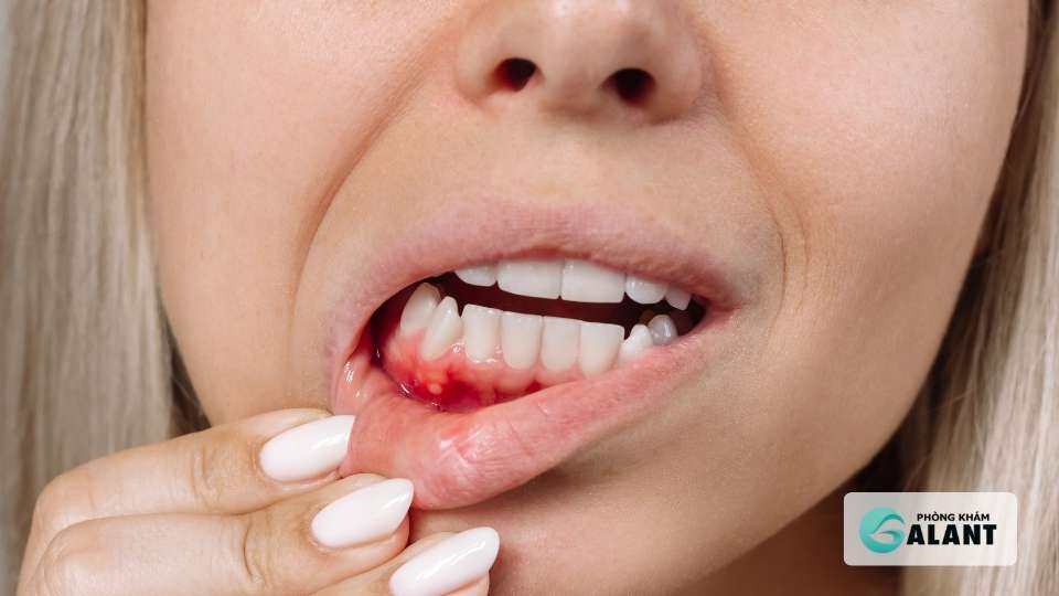 Sùi mào gà có lây qua hôn không?