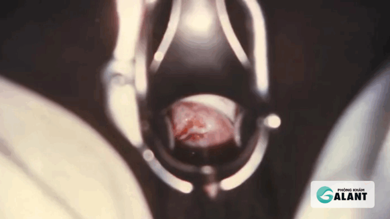 Bệnh lậu có mủ