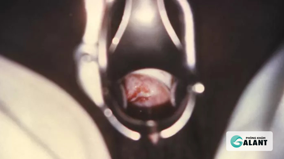 Bệnh lậu có mủ