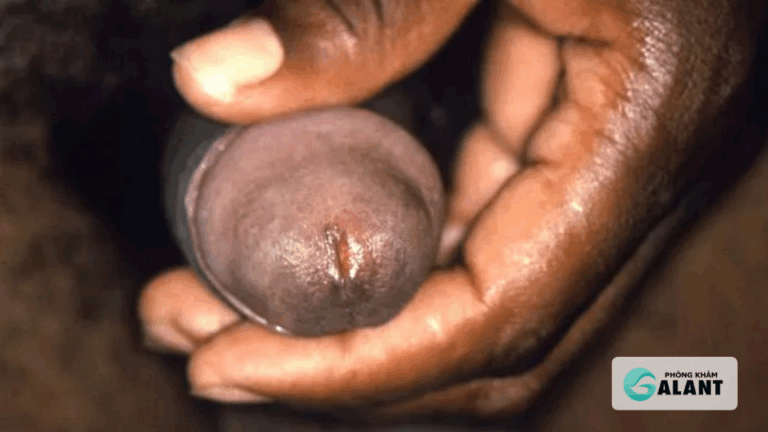 triệu chứng bệnh lậu ở Nam