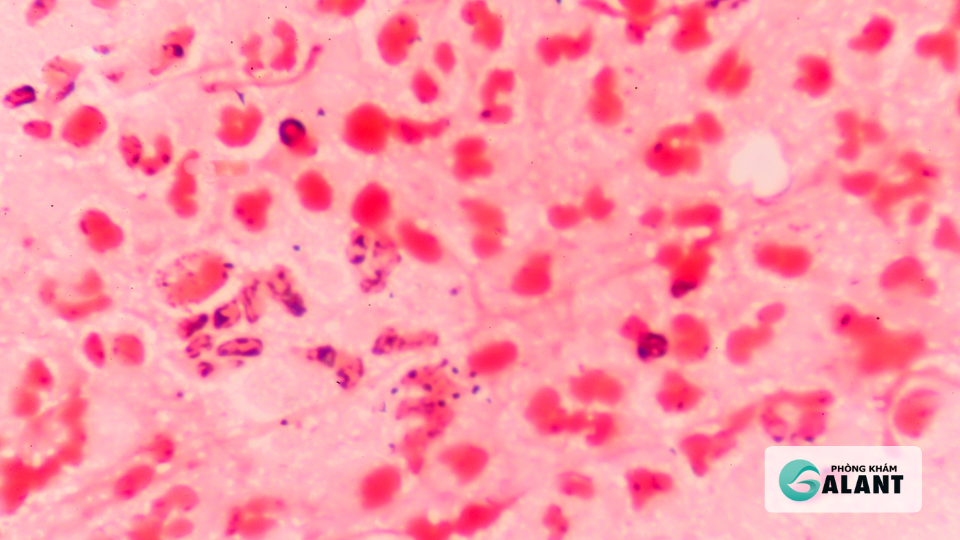 thời gian ủ bệnh Lậu