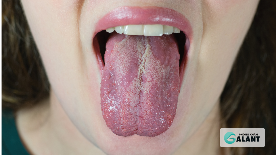 Sùi mào gà có lây qua quan hệ miệng không?