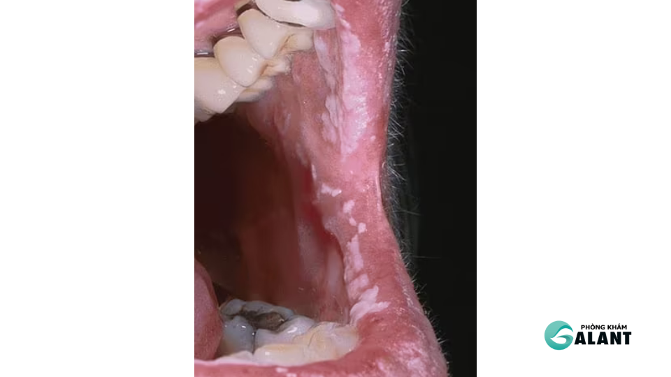 vị trí xuất hiện sùi mào gà khó quan sát