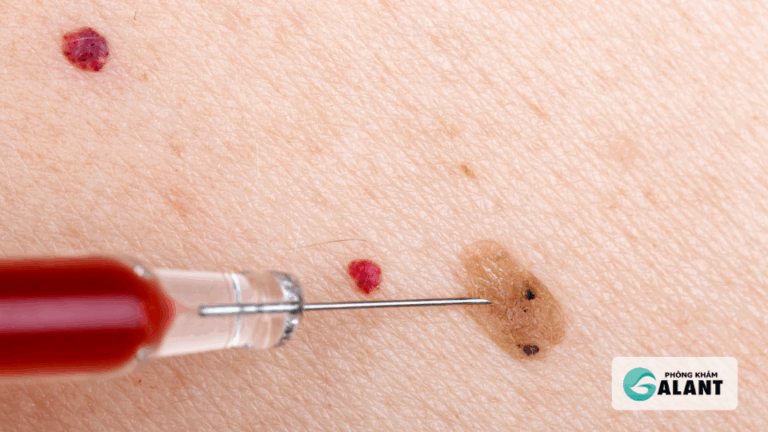 Tiêm vắc xin HPV phòng ngừa Sùi mào gà