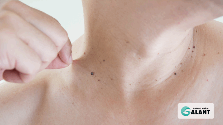 Sùi mào gà vẫn có thể tái phát sau khi đốt