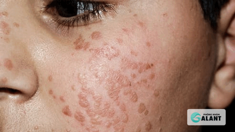 Dấu hiệu sùi mào gà ở trẻ nhỏ