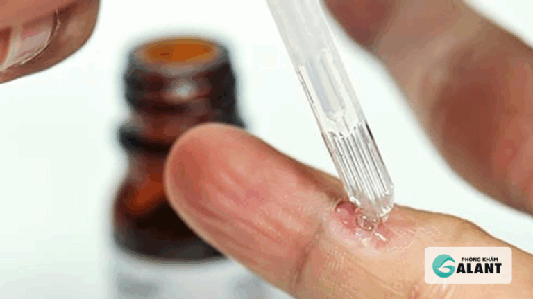 cách dùng thuốc Podophyllotoxin trị sùi mào gà