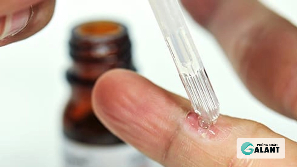 Podophyllotoxin trị sùi mào gà: Cách dùng, hiệu quả