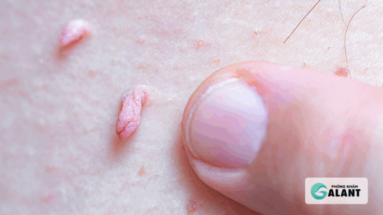 Nguyên nhân khiến cho sùi mào gà tái phát