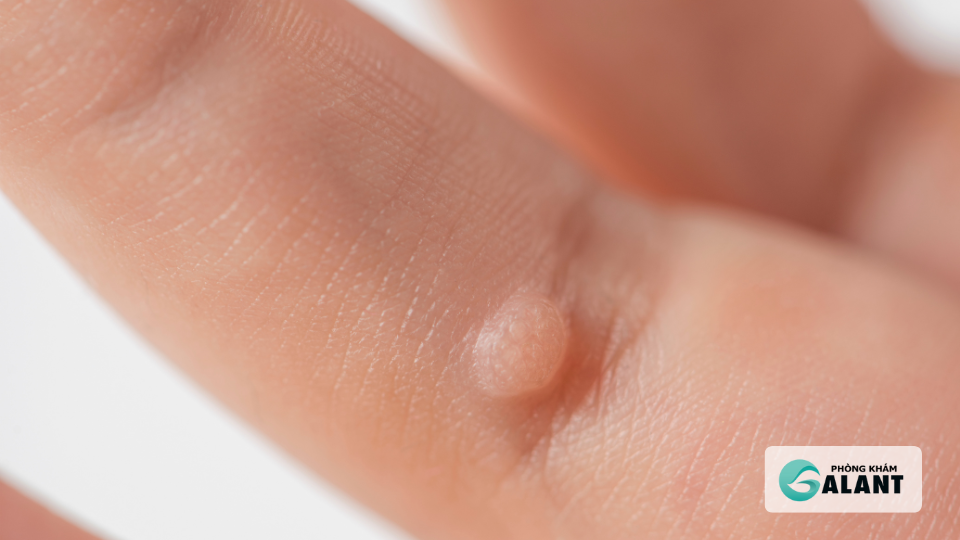 HPV gây mụn cóc thông thường