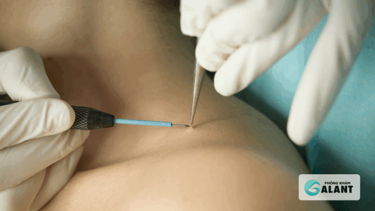 Đốt điện hay laser khi điều trị sùi mào gà