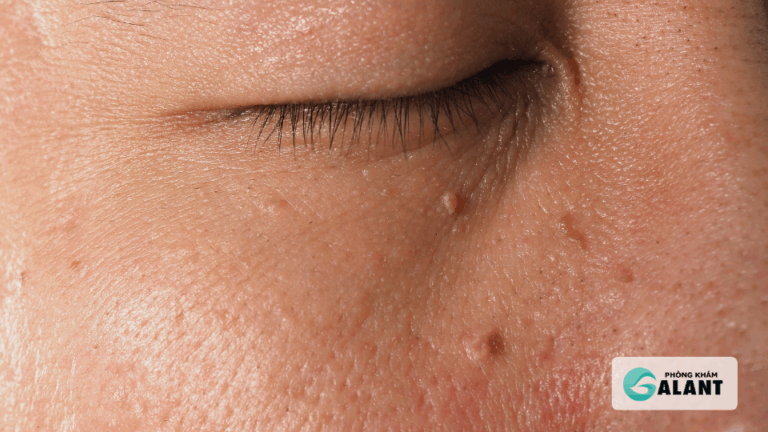 sùi mào gà hiếm khi tự khỏi mà tiến triển nặng hơn