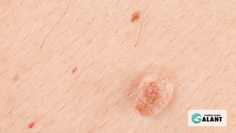 đốt điện hay Laser chữa sùi mào gà