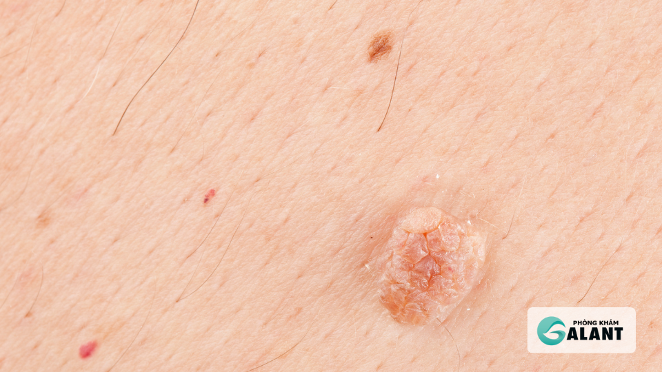 đốt điện hay Laser chữa sùi mào gà