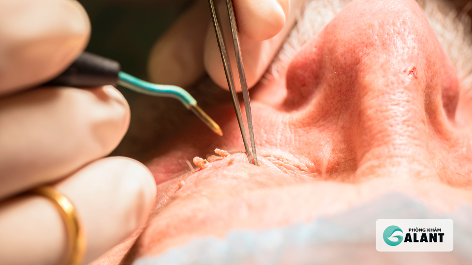 đốt điện sùi mào gà